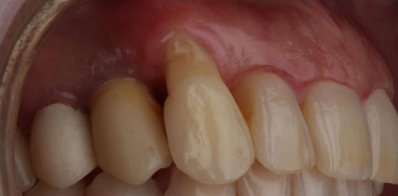 Comparação antes e depois do enxerto gengival - antes