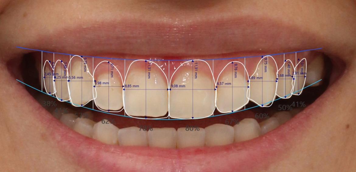 Planejamento digital do sorriso com demarcações e proporções dentárias