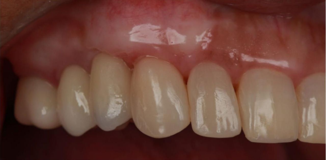 Comparação antes e depois do enxerto gengival - depois